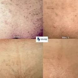 Depilación Definitiva de Pubis.
