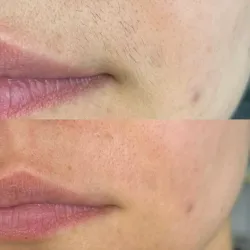 Depilacion definitva de Bigote.