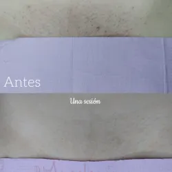 Depilación Láser de Zona Intima Completa.