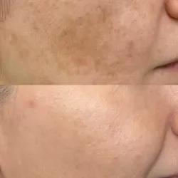 Hollywood Peel para Melasma y otras Manchas de la Piel.