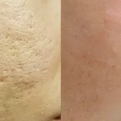 Laser CO2 Fraccionado en el Rostro.