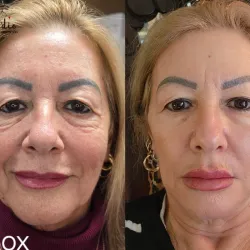 Relleno de Pómulos con Ácido Hialuronico.