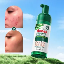 MOUSSE DE LIMPIEZA FACIAL ACNES OIL CONTROL 150G – SADOER
