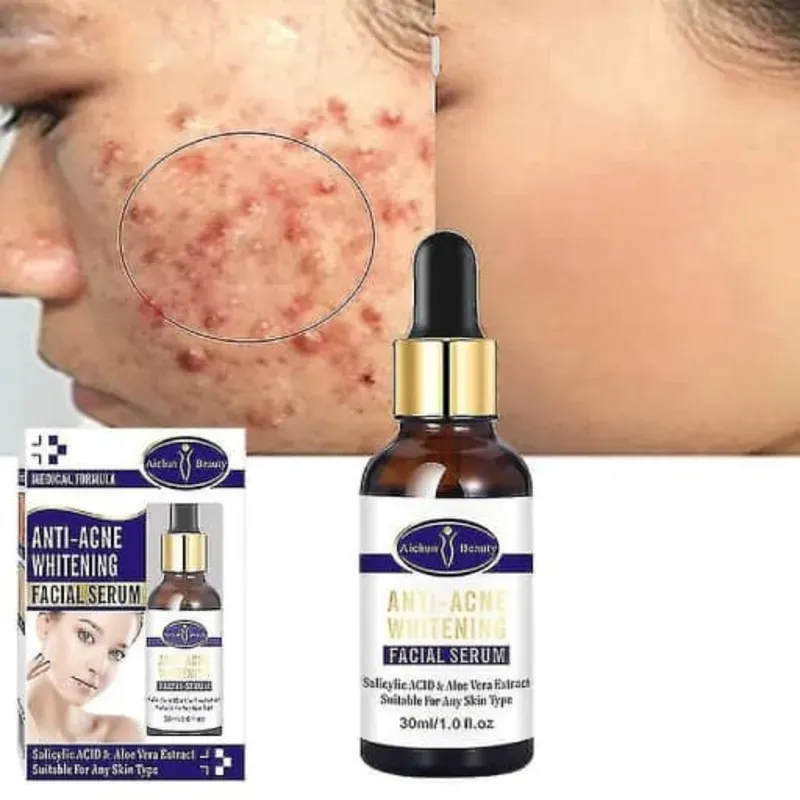 Serum anti-acné blanqueador
