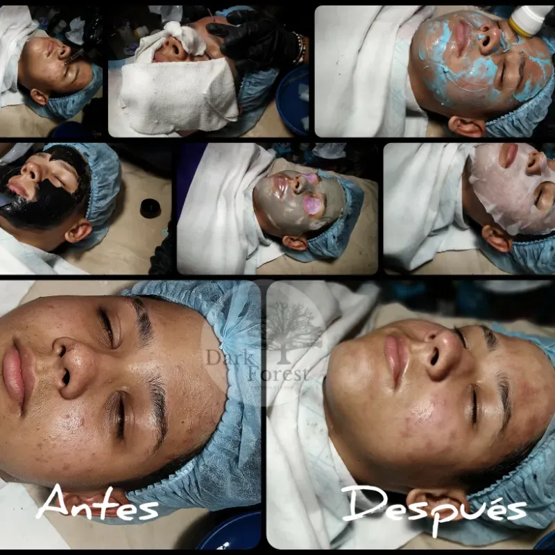 Limpieza facial profunda