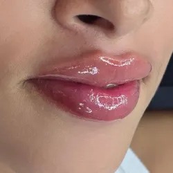 Aumento de labios