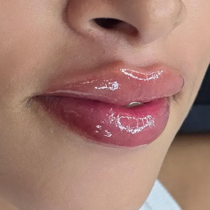 Aumento de labios