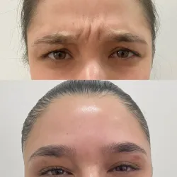 Bótox en Entrecejo 💉
