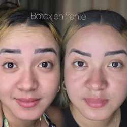Bótox en Frente 💉