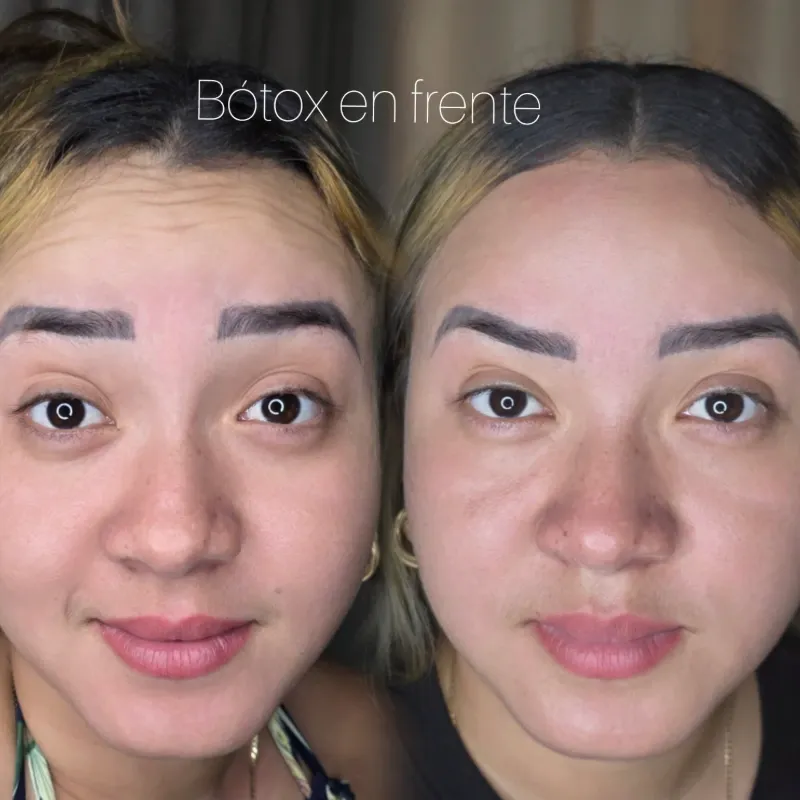 Bótox en Frente 💉