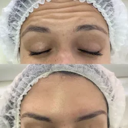 Bótox en Frente 💉