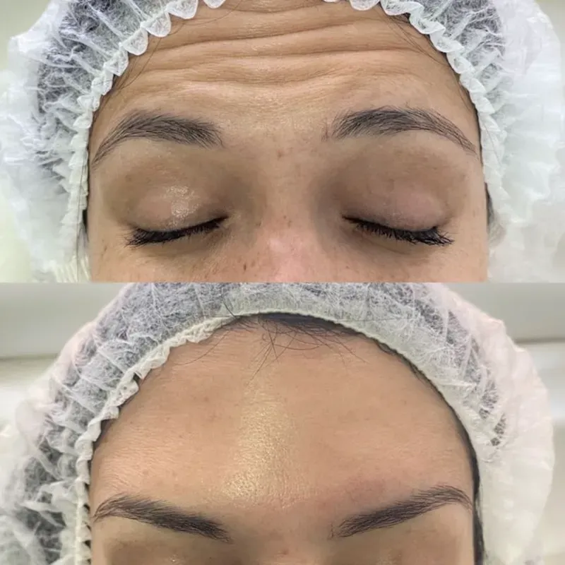 Bótox en Frente 💉