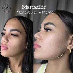 Proyección del mentón