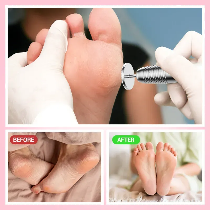 Kit podiscos 3 medidas