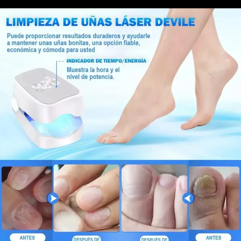 Equipo láser para tratar las uñas enfermeras 