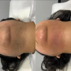 Depilacion de barbilla 