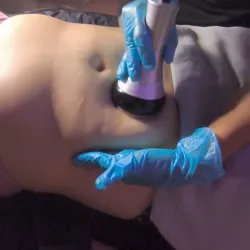 Cavitación Radiofrecuencia y vacumterapia