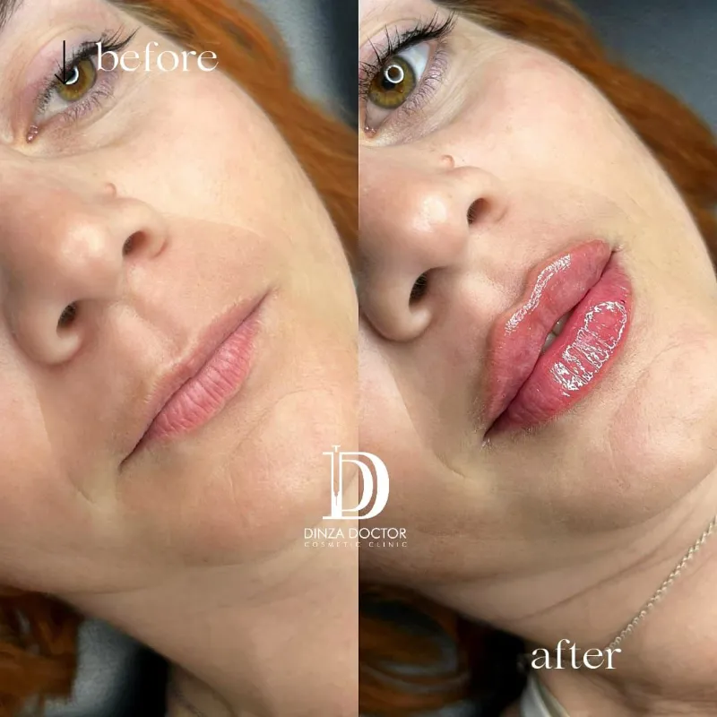 Aumento de Labios 👄😍