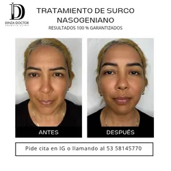 Relleno de surcos nasogenianos ✨😍