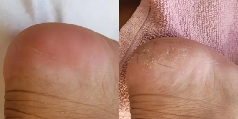 Pedicura 
