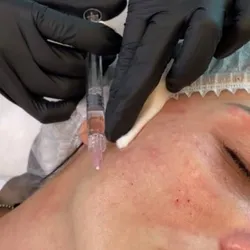 Armonización facial (Pómulos, Rinomodelación, Marcaje mandibular)