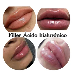 Aumento con Ácido Hialurónico