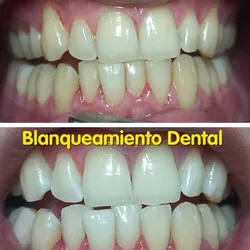 Blanqueamiento dental