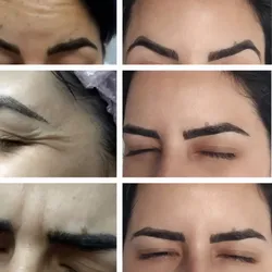 Bótox