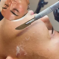 Dermaplaning