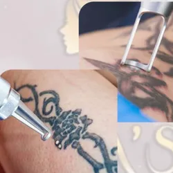 Eliminación de tatuajes