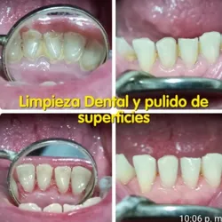 Limpieza dental