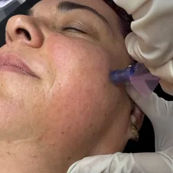 Microneedling