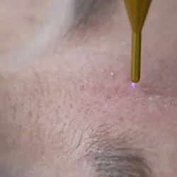 Plasma pen léntigos solares