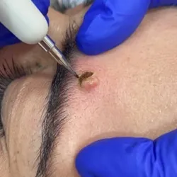 Plasma pen verrugas