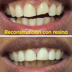 Reconstrucciones dentales