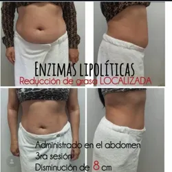 Reducción de medidas con Lipo-enzimas (lipoflak)