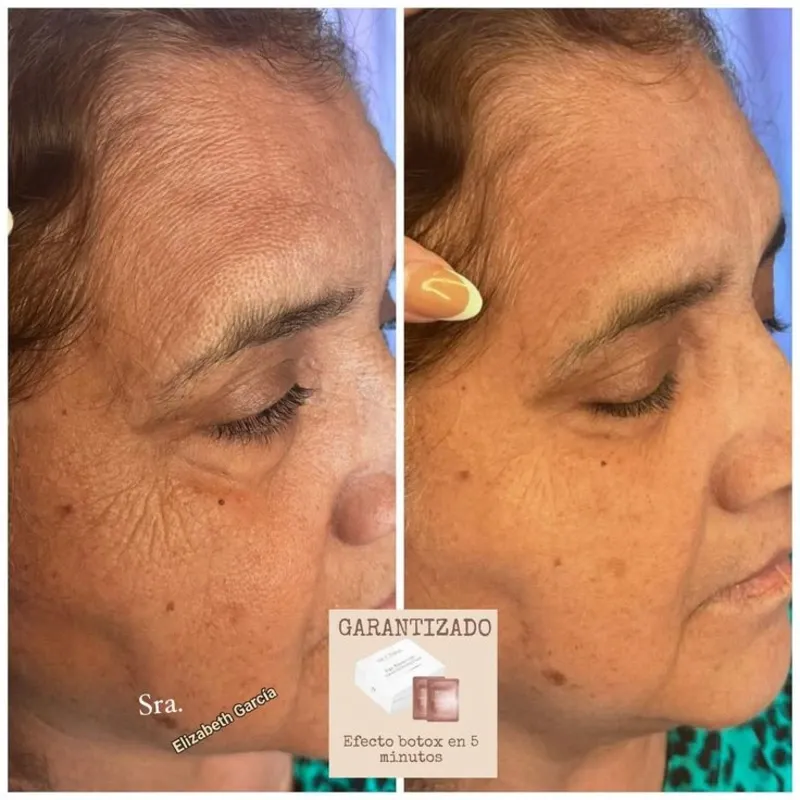 Botox Instantáneo Farmasi