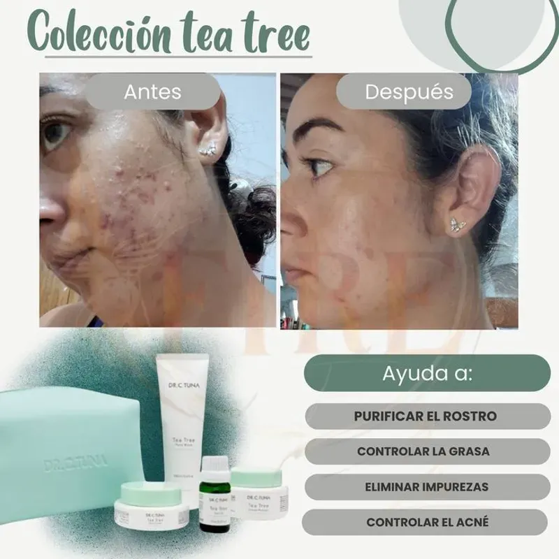 Jabón de Té Tree 125g (Para eliminar el acné)