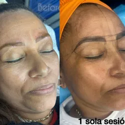 BIOMICRONEEDLING_Microagujas Biológicas 