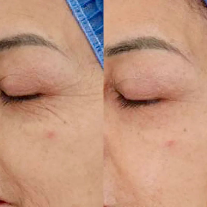 HILOS MÁGICOS REABSORVIBLES_Coreanos