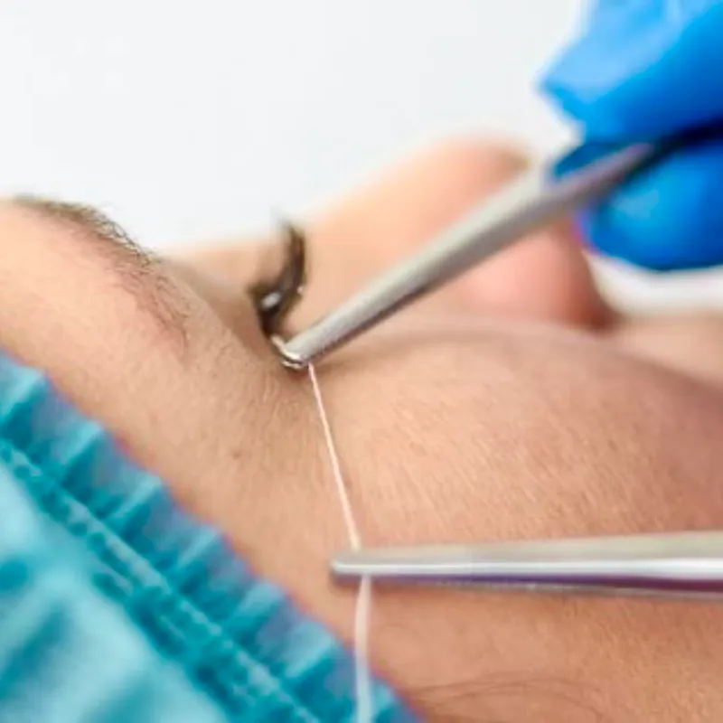 HILOS MÁGICOS REABSORVIBLES_Coreanos