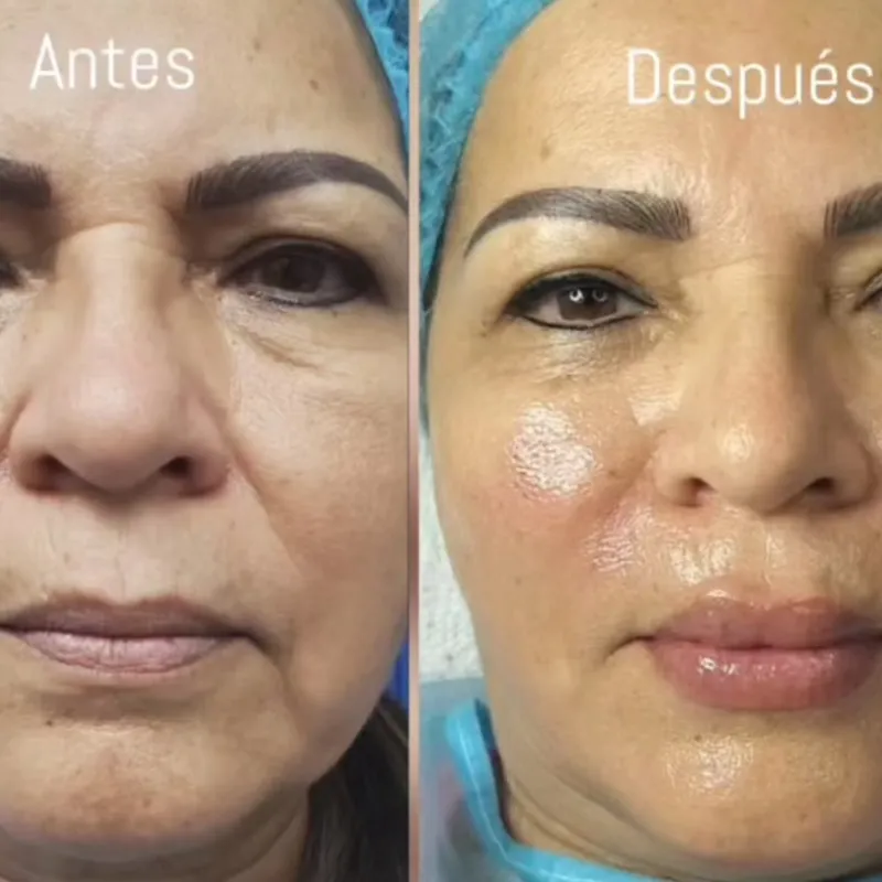 ARMONIZACIÓN_Relleno de Surcos, Pómulos, etc…