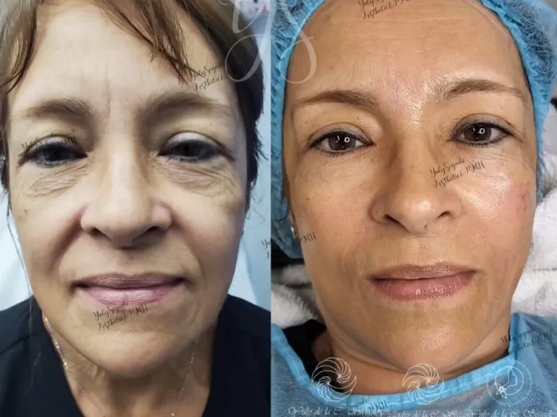 FILLERS_Rellenos con Ácido Hialurónico 