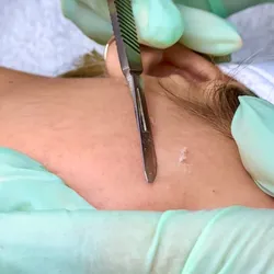 DERMAPLANING CON ACTIVOS