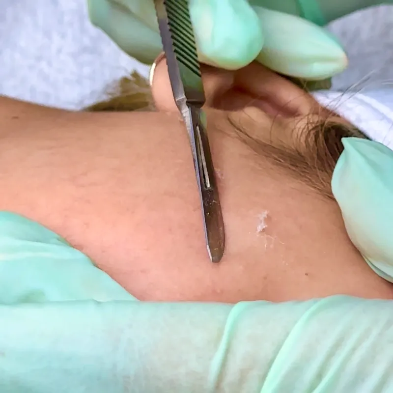 DERMAPLANING CON ACTIVOS