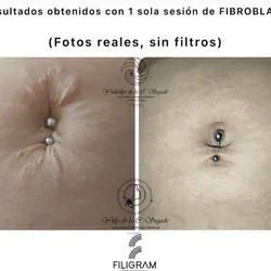 FIBROBLAST_Plasma Pen