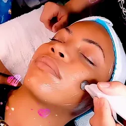 FIBROELECTROLIFTING /FEP