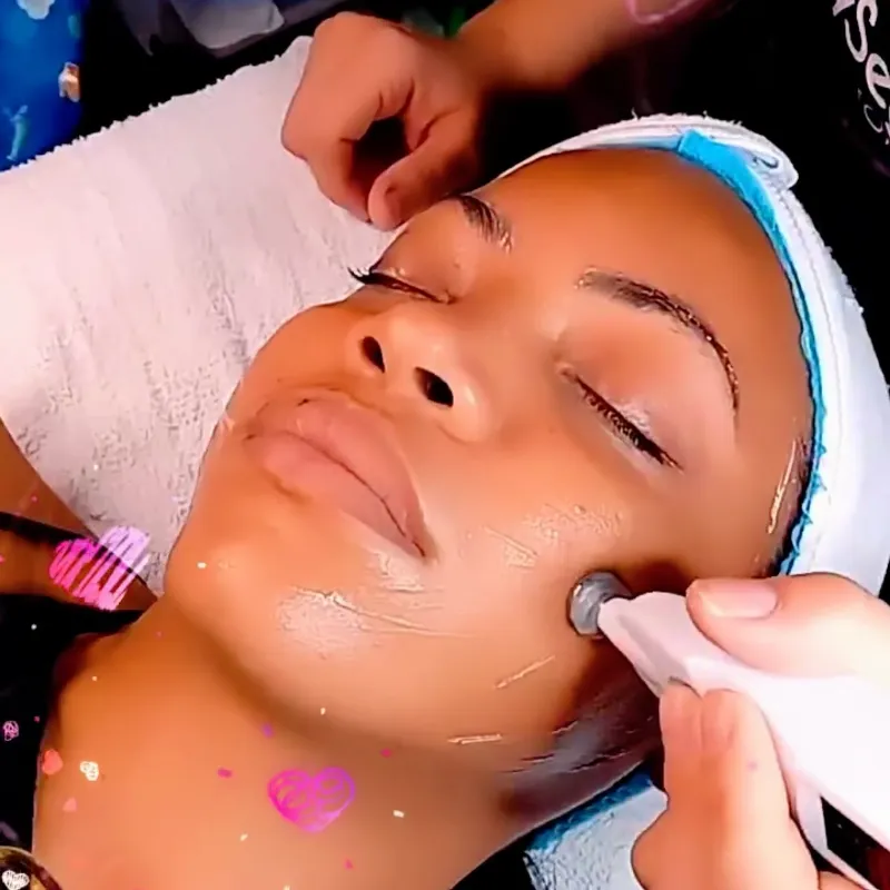 FIBROELECTROLIFTING /FEP