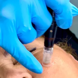 MICRONEEDLING_”Dermapen”