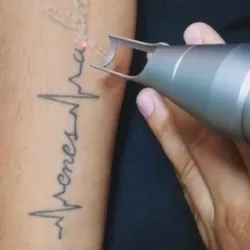 ELIMINACIÓN DE TATUAJES CON LASER